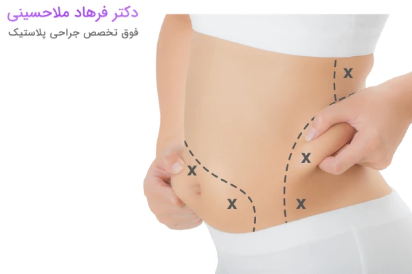 انواع ابدومینوپلاستی