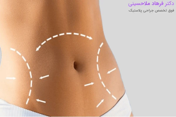 مزایای ابدومینوپلاستی