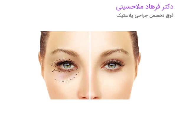 بلفاروپلاستی چیست؟