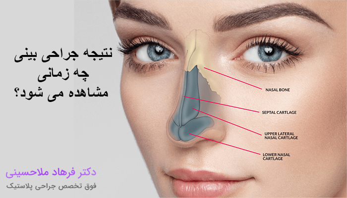 نتیجه جراحی بینی چه زمانی مشاهده می شود؟