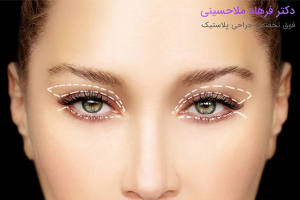 مزایای بلفاروپلاستی