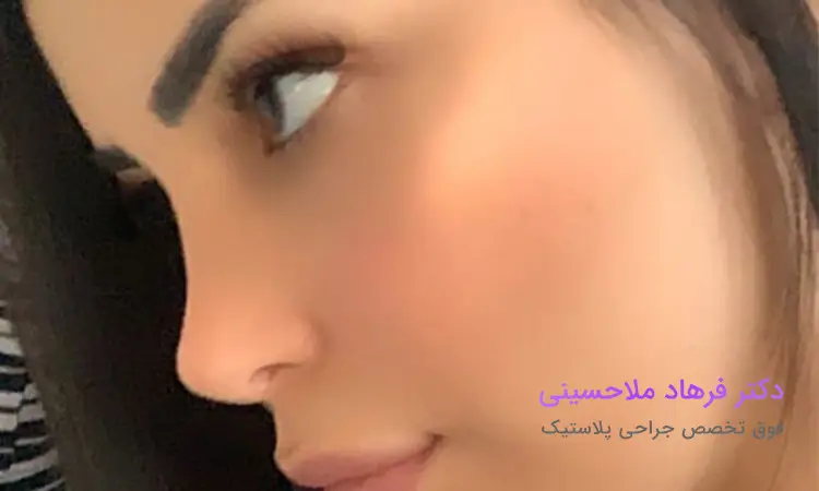 جراحی بینی فانتزی در بندرعباس مناسب چه افرادی است؟
