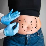 آمبولی بعد از پیکرتراشی