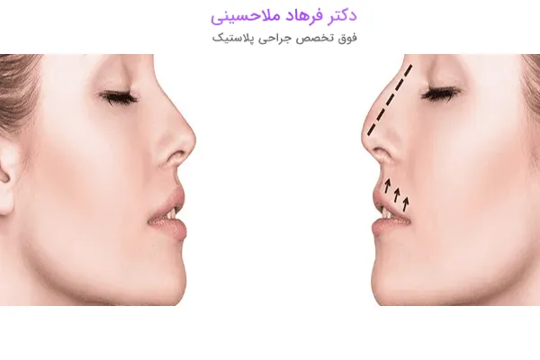 سن مناسب عمل بینی