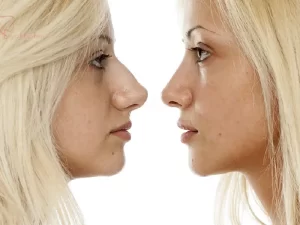 عمل بینی طبیعی