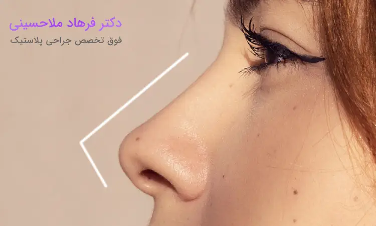 نکات قبل از عمل بینی طبیعی