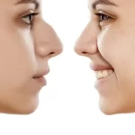 عوارض عمل بینی