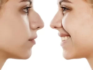 عوارض عمل بینی