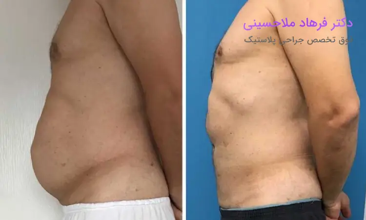 آیا همه افراد دچار عوارض پیکرتراشی می شوند؟