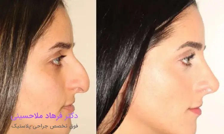 جراحی بینی استخوانی