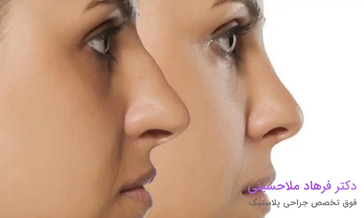 نکات قبل از جراحی بینی استخوانی