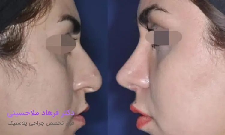 جراحی بینی گوشتی چیست؟