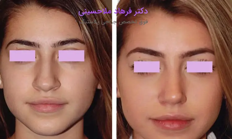 مراقبتهای پس از جراحی بینی گوشتی