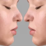 عمل ترمیمی بینی