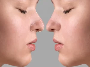 عمل ترمیمی بینی