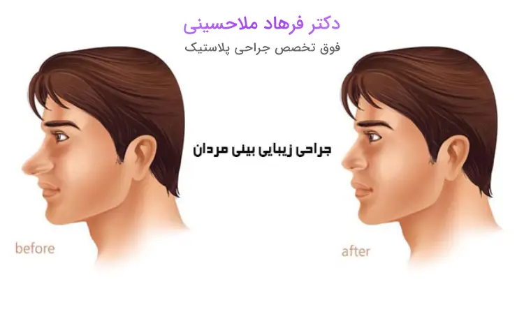 مراقبت‌های قبل از انجام عمل بینی مردانه