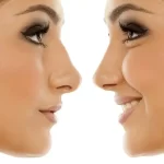 عمل بینی غضروفی