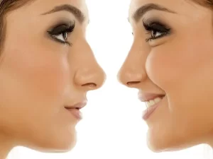 عمل بینی غضروفی