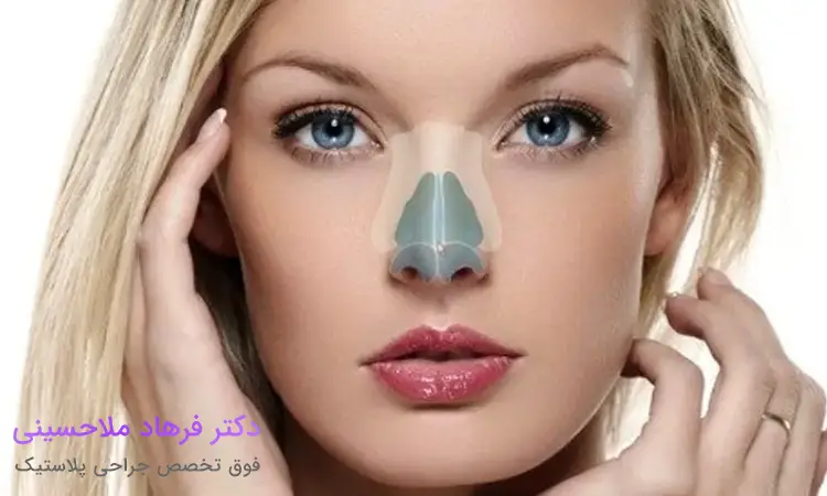 عمل بینی غضروفی چیست؟