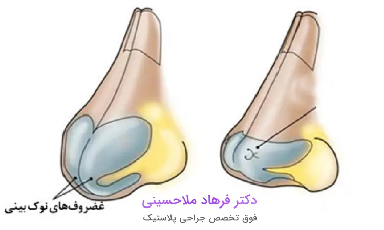 نحوه عمل بینی غضروفی