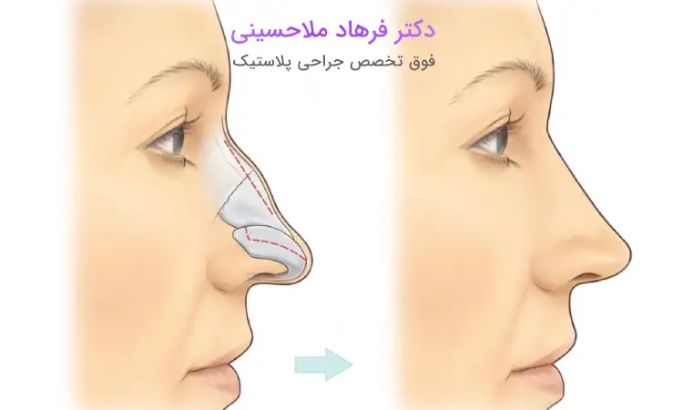 تکنیک‌های انواع جراحی بینی