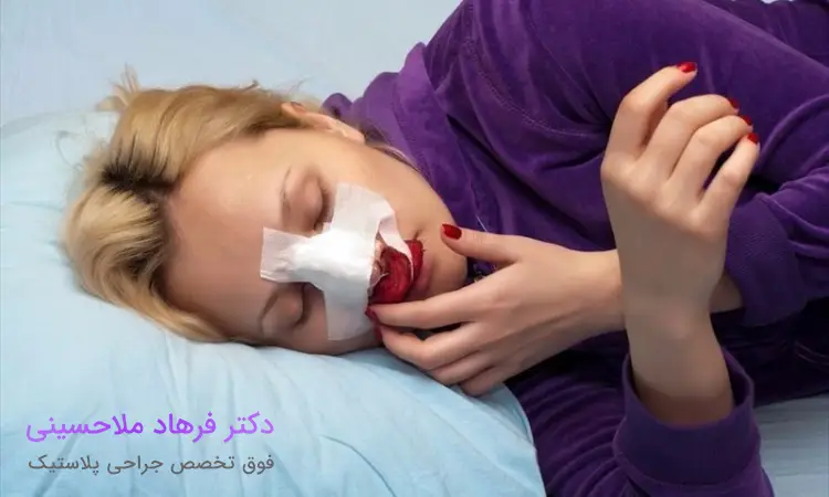 اهمیت نحوه خوابیدن بعد از عمل بینی