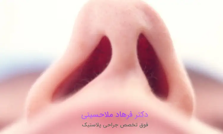 مراقبت‌های قبل وبعد از درمان انحراف بینی