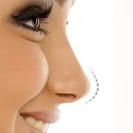 سفت شدن نوک بینی بعد از عمل