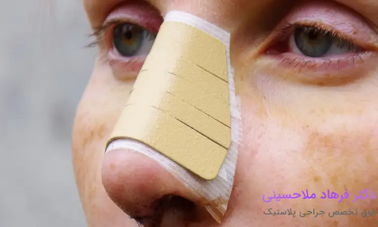 علت ورم بینی بعد از عمل