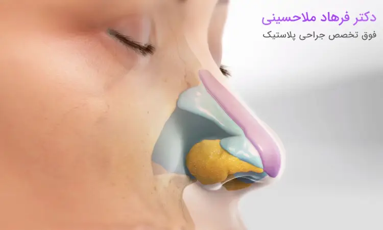 ورم بینی بعد از عمل چه زمانی از بین می‌رود؟