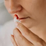 خونریزی بعد از عمل بینی