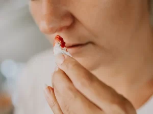 خونریزی بعد از عمل بینی