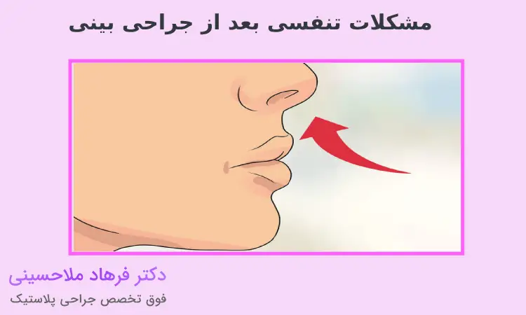 انواع مشکلات تنفسی بعد از جراحی بینی
