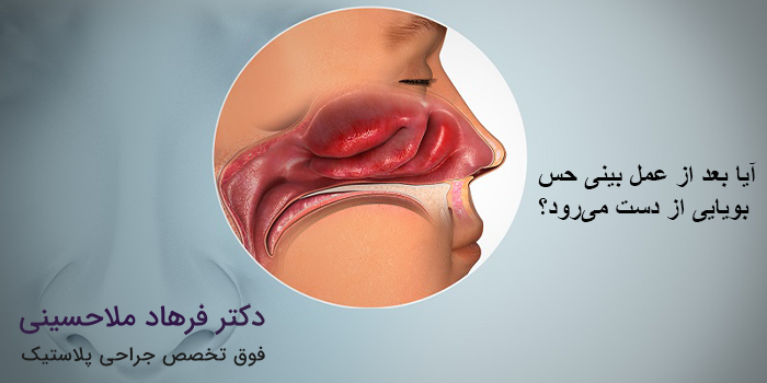 آیا بعد از عمل بینی حس بویایی از دست میرود؟