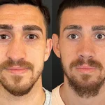 جراحی بینی شکسته