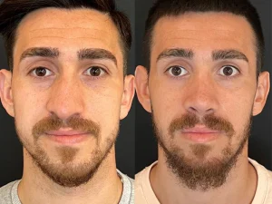 جراحی بینی شکسته