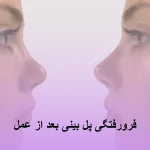 فرورفتگی پل بینی