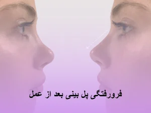 فرورفتگی پل بینی