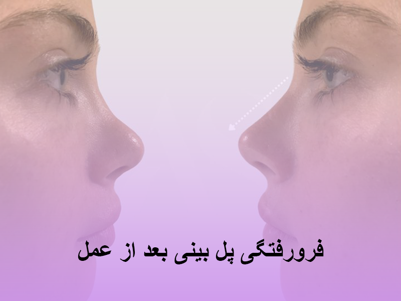 فرورفتگی پل بینی