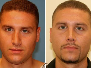 جراحی بینی کج