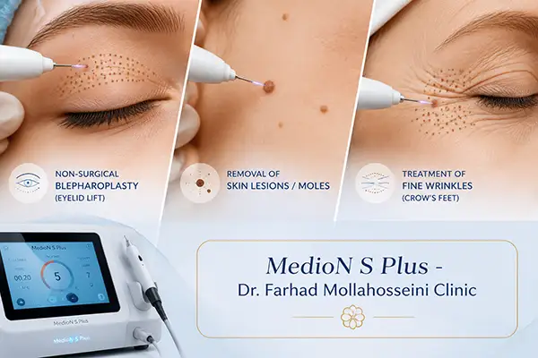 دستگاه پلاسما تراپی MedioN S Plus برای جوانسازی در کلینیک بندرعباس