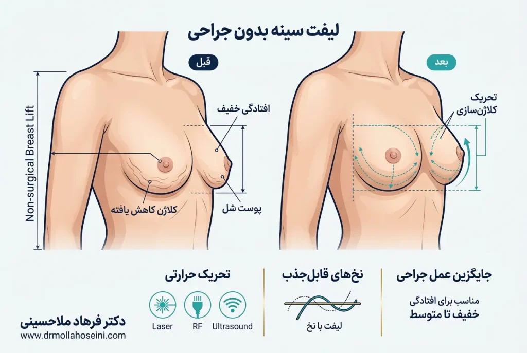 لیفت سینه بدون جراحی