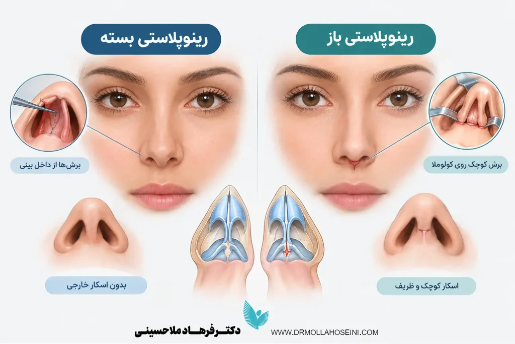 تفاوت عمل بینی باز و بسته | دکتر فرهاد ملاحسینی