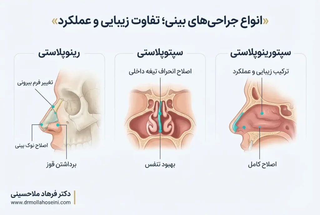 مقایسه رینوپلاستی ،سپتوپلاستی و سپتورینوپلاستی | دکتر ملاحسینی