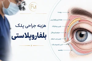 هزینه جراحی پلک دکتر ملاحسینی