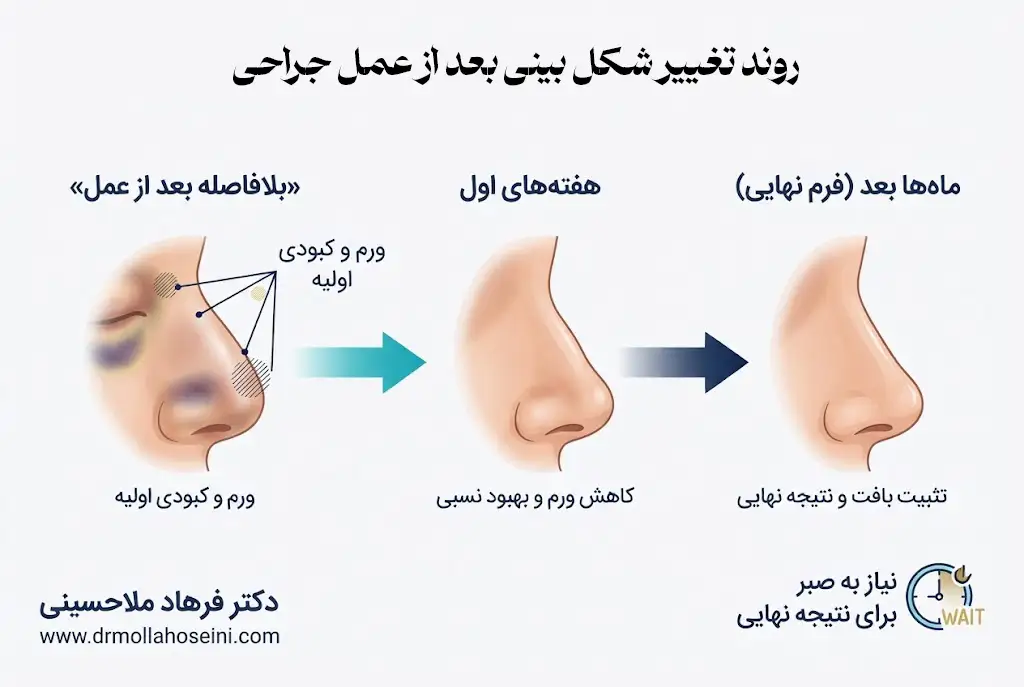 روند تغییر شکل بینی بعد از عمل جراحی | دکتر فرهاد ملاحسینی