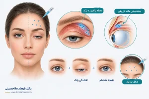 افتادگی پلک بعد از تزریق بوتاکس