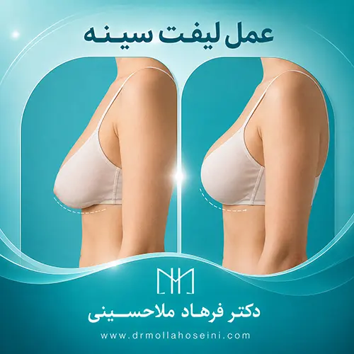 جراحی لیفت سینه در بندرعباس - دکتر فرهاد ملاحسینی