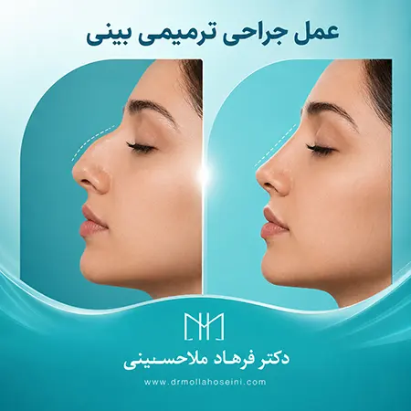 جراحی ترمیمی بینی در بندرعباس- دکتر فرهاد ملاحسینی