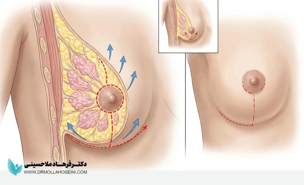 لیفت سینه جراحی دقیقاً چه کاری انجام میدهد؟